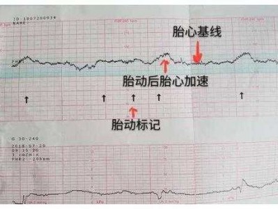 胎心监测仪（胎心监测仪找不到胎心怎么回事）