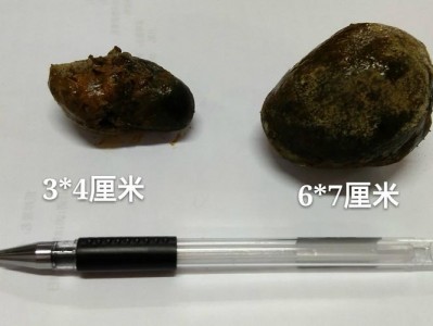 8mm（8mm结石能排出来吗）