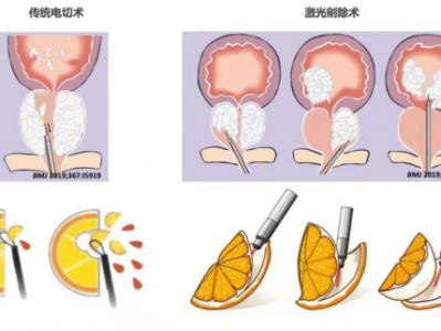 绿激光（绿激光前列腺剜除术优缺点）