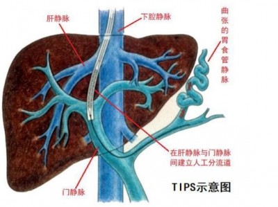 门静（门静脉主干内径10mm正常吗）