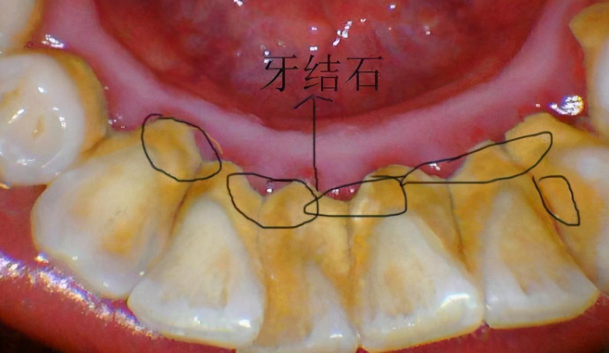 用手扣（用手扣下牙结石）