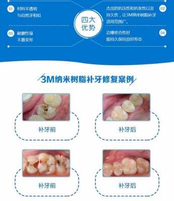 什么是树脂（什么是树脂补牙）