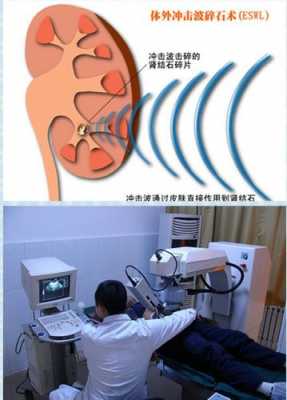 超声波碎石多少钱（体外碎石后要休息几天）