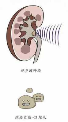 超声波碎石多少钱（体外碎石后要休息几天）