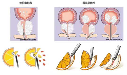 绿激光（绿激光前列腺剜除术优缺点）