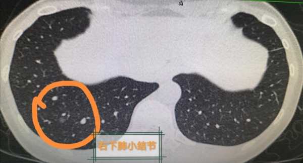 毛玻璃（毛玻璃肺结节5mm严重吗）