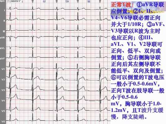 T门（t波低平）