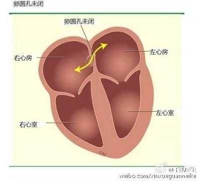 圆孔（圆孔未闭合有什么影响）