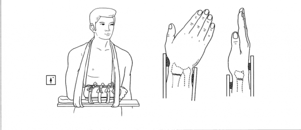 夹板（夹板的正确使用方法）
