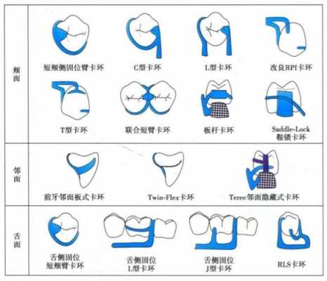 联合卡环（联合卡环图解）