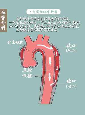 夹层是什么意思（动脉夹层前10天征兆）